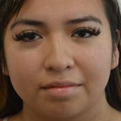 Before Image: Rhinoplasty & Chin Implant by Dr. Thompson - front