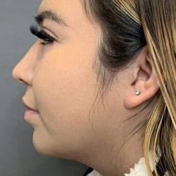After Image: Rhinoplasty & Chin Implant by Dr. Thompson - left-side