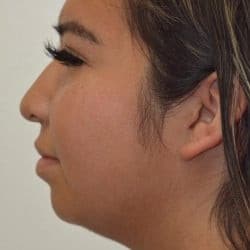 Before Image: Rhinoplasty & Chin Implant by Dr. Thompson - left-side