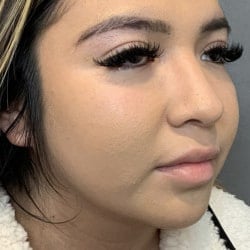 After Image: Rhinoplasty & Chin Implant by Dr. Thompson - right-front-oblique