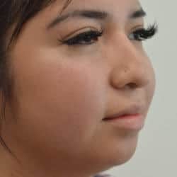 Before Image: Rhinoplasty & Chin Implant by Dr. Thompson - right-front-oblique