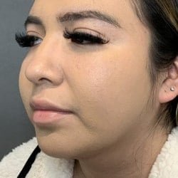 After Image: Rhinoplasty & Chin Implant by Dr. Thompson - left-front-oblique
