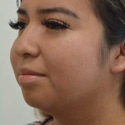Before Image: Rhinoplasty & Chin Implant by Dr. Thompson - left-front-oblique