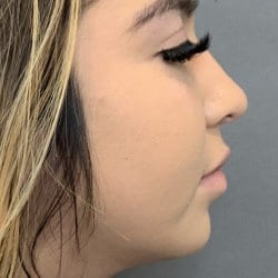 After Image: Rhinoplasty & Chin Implant by Dr. Thompson - right-side