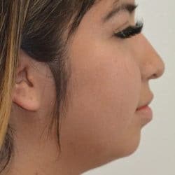 Before Image: Rhinoplasty & Chin Implant by Dr. Thompson - right-side