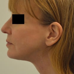 After Image: Facelift, Chin Implant, Periorbital Fat Transfer by Dr. Thompson - left-side