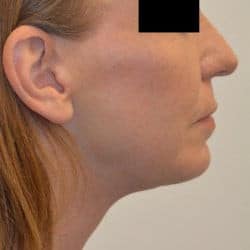 After Image: Facelift, Chin Implant, Periorbital Fat Transfer by Dr. Thompson - right-side