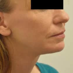 After Image: Facelift, Chin Implant, Periorbital Fat Transfer by Dr. Thompson - right-front-oblique