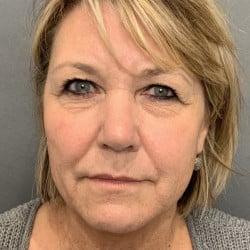 Before Image: Facelift & Lower Blepharoplasty by Dr. Thompson - front