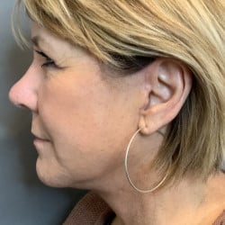 After Image: Facelift & Lower Blepharoplasty by Dr. Thompson - left-side