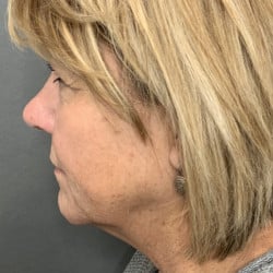 Before Image: Facelift & Lower Blepharoplasty by Dr. Thompson - left-side