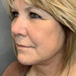 After Image: Facelift & Lower Blepharoplasty by Dr. Thompson - left-front-oblique