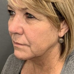 Before Image: Facelift & Lower Blepharoplasty by Dr. Thompson - left-front-oblique