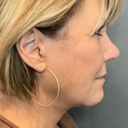 After Image: Facelift & Lower Blepharoplasty by Dr. Thompson - right-side