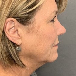 Before Image: Facelift & Lower Blepharoplasty by Dr. Thompson - right-side