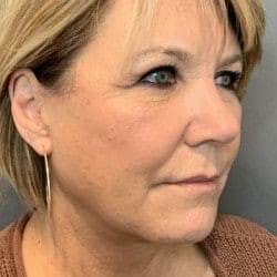 After Image: Facelift & Lower Blepharoplasty by Dr. Thompson - right-front-oblique