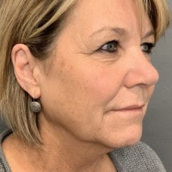 Before Image: Facelift & Lower Blepharoplasty by Dr. Thompson - right-front-oblique
