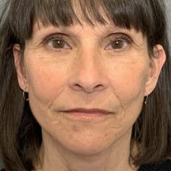 After Image: Facelift, Fat Transfer, and Lower Blepharoplasty by Dr. Thompson - front