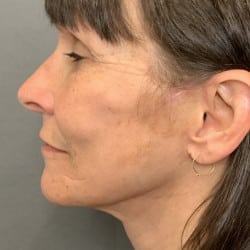 After Image: Facelift, Fat Transfer, and Lower Blepharoplasty by Dr. Thompson - left-side