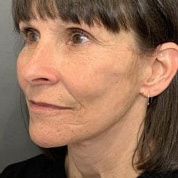After Image: Facelift, Fat Transfer, and Lower Blepharoplasty by Dr. Thompson - left-front-oblique