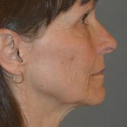Before Image: Facelift, Fat Transfer, and Lower Blepharoplasty by Dr. Thompson - right-side