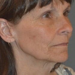 Before Image: Facelift, Fat Transfer, and Lower Blepharoplasty by Dr. Thompson - right-front-oblique