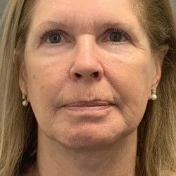 After Image: Facelift, Upper & Lower Blepharoplasty by Dr. Thompson - front