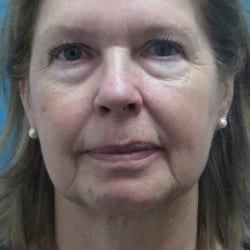 Before Image: Facelift, Upper & Lower Blepharoplasty by Dr. Thompson - front