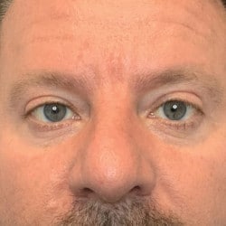 After Image: Upper Blepharoplasty by Dr. Henstrom