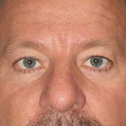 Before Image: Upper Blepharoplasty by Dr. Henstrom