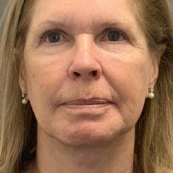 After Image: Facelift, Upper & Lower Blepharoplasty by Dr. Thompson - front