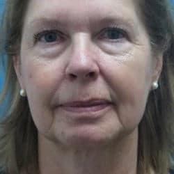 Before Image: Facelift, Upper & Lower Blepharoplasty by Dr. Thompson - front