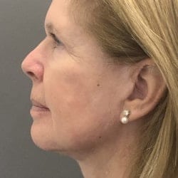 After Image: Facelift, Upper & Lower Blepharoplasty by Dr. Thompson - left-side