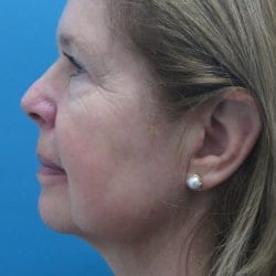 Before Image: Facelift, Upper & Lower Blepharoplasty by Dr. Thompson - left-side