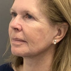 After Image: Facelift, Upper & Lower Blepharoplasty by Dr. Thompson - left-front-oblique