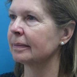 Before Image: Facelift, Upper & Lower Blepharoplasty by Dr. Thompson - left-front-oblique