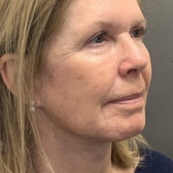 After Image: Facelift, Upper & Lower Blepharoplasty by Dr. Thompson - right-front-oblique