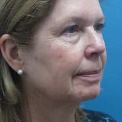 Before Image: Facelift, Upper & Lower Blepharoplasty by Dr. Thompson - right-front-oblique
