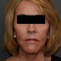 After Image: Facelift, Fat Transfer, Perioral Dermabrasion by Dr. Thompson - front