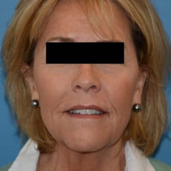 Before Image: Facelift, Fat Transfer, Perioral Dermabrasion by Dr. Thompson - front