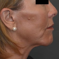 After Image: Facelift, Fat Transfer, Perioral Dermabrasion by Dr. Thompson - right-side