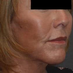 After Image: Facelift, Fat Transfer, Perioral Dermabrasion by Dr. Thompson - right-front-oblique