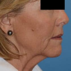 Before Image: Facelift, Fat Transfer, Perioral Dermabrasion by Dr. Thompson - right-front-oblique