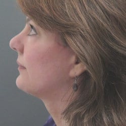 After Image: Facelift by Dr. Thompson - left-side