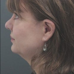 Before Image: Facelift by Dr. Thompson - left-side
