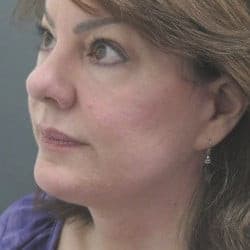 After Image: Facelift by Dr. Thompson - left-front-oblique