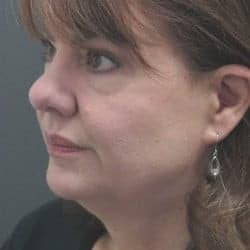 Before Image: Facelift by Dr. Thompson - left-front-oblique