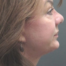 After Image: Facelift by Dr. Thompson - right-side