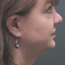 Before Image: Facelift by Dr. Thompson - right-side