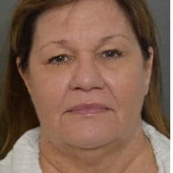 Before Image: Facelift and Upper Blepharoplasty by Dr. Thompson - front